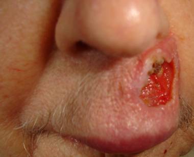 Ulcer On Lip